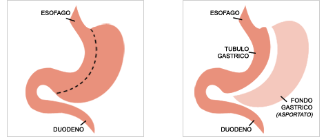 Tubulizzazione Gastrica Laparoscopica